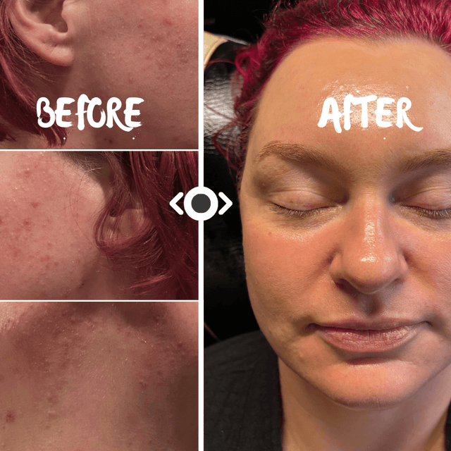 Hyperpigmentation Correction 